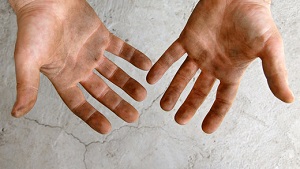 Nemoc špinavých rukou